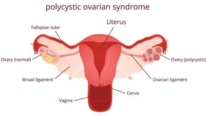 best ivf doctor for infertility in pcod in vashi